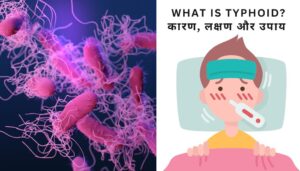Read more about the article Typhoid Kya Hota Hai – टाइफाइड के कारण, लक्षण और उपचार 